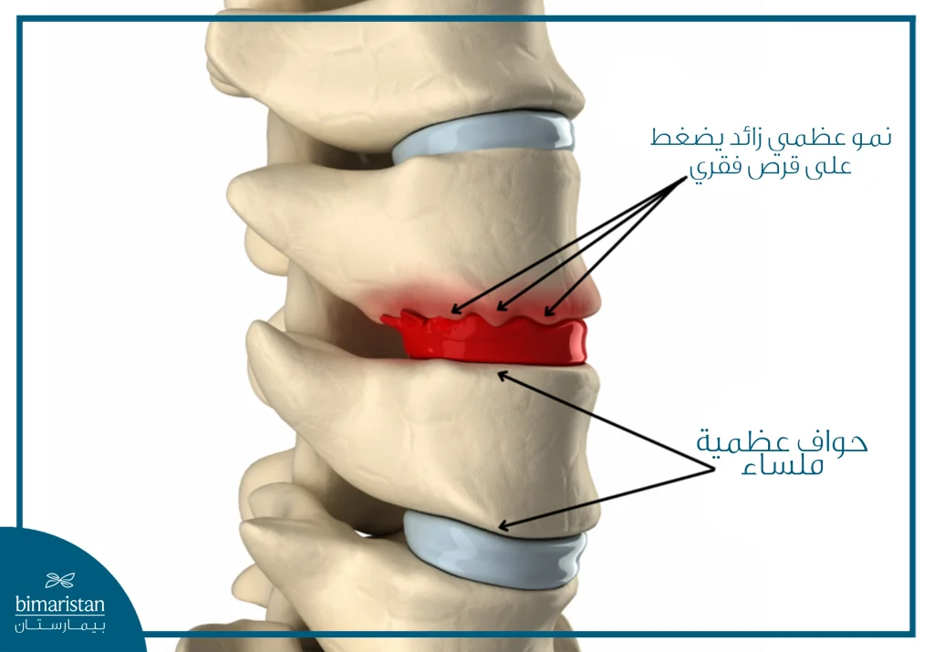 مناقير الرقبة: الأسباب والأعراض وطرق العلاج 10 صورة توضح الفرق بين الحالة الطبيعية للفقرات ومناقير الرقبة