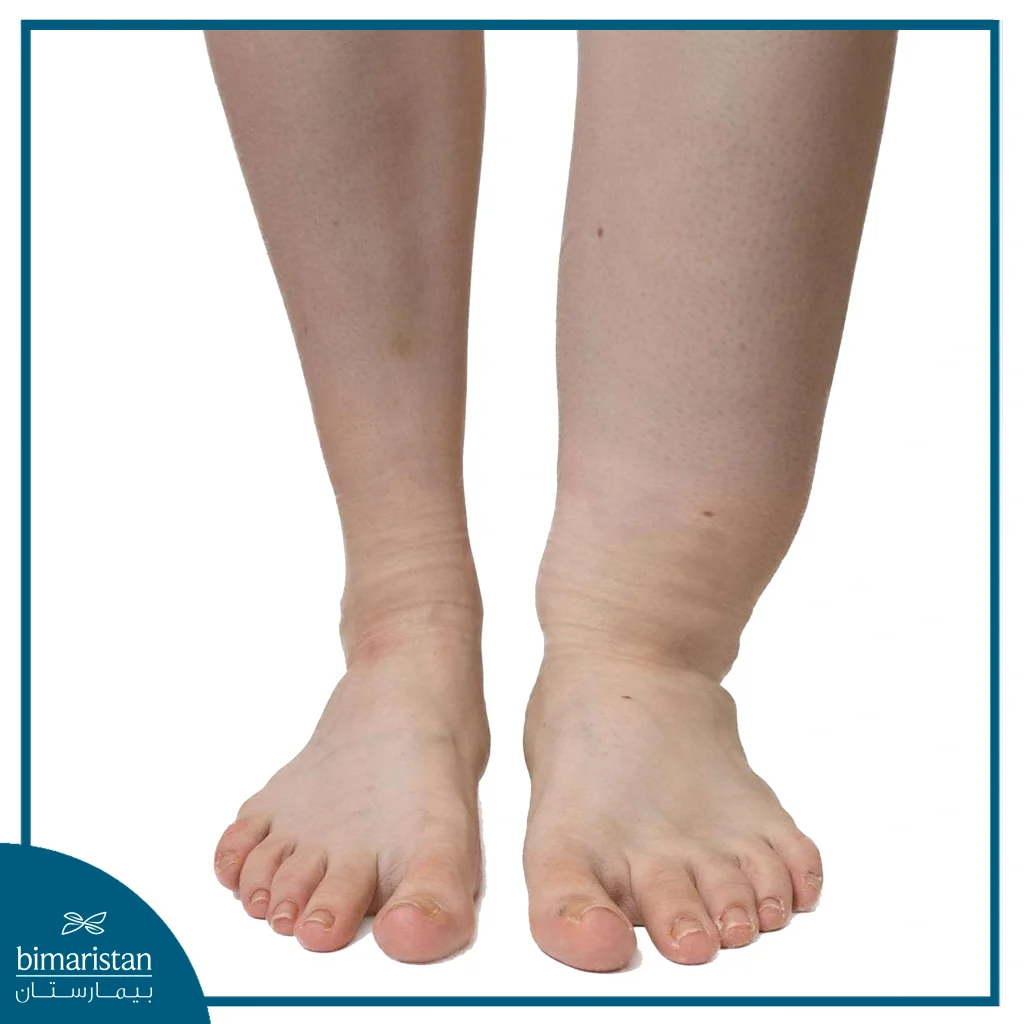 تحويلة غسيل الكلى - التحويلة الشريانية الوريدية 3 صورة توضح الفرق بين الساق السليمة والساق المتوذمة