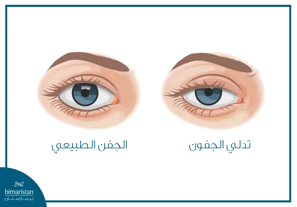 صورة توضح الفرق بين العين السليمة والعين المصابة بتدلي الجفون