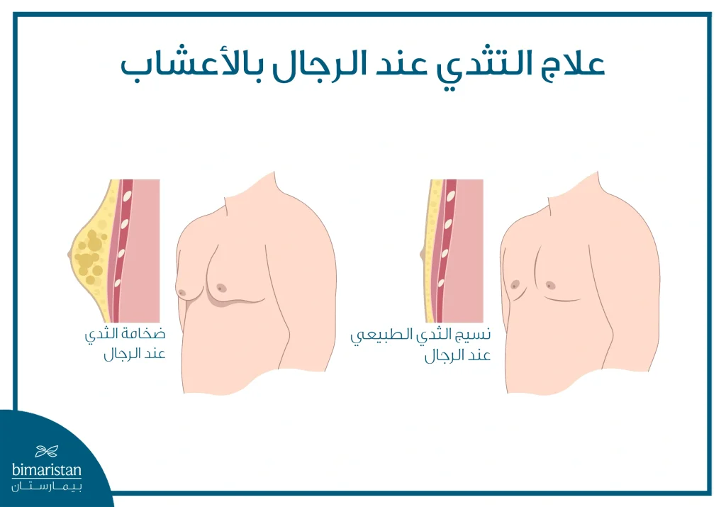 طرق آمنة وطبيعية لعلاج التثدي عند الرجال بالأعشاب 2 صورة توضح الفرق ما بين رجل طبيعي ورجل مصاب بالتثدي