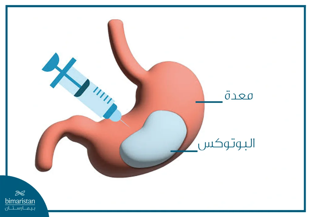 بوتوكس المعدة في تركيا: أفضل علاج للسمنة 2025 3 بوتوكس المعدة: كل ما تريد معرفته عن هذا الإجراء