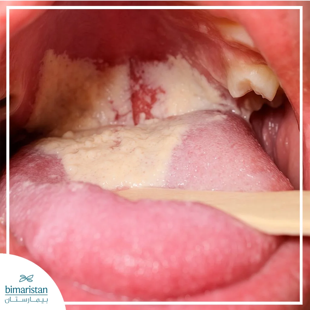 أسباب نزيف اللثة: علامة بسيطة أم إنذار لمرض خطير 4 صورة توضح تأثير العلاج الكيميائي على اللثة واللسان والفم