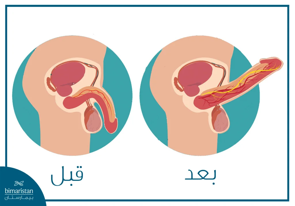 ضعف الانتصاب: الأسباب والتشخيص والعلاج 5 صورة توضح تأثير علاج ضعف الانتصاب