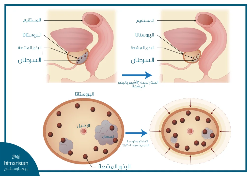صورة توضح تراجع حجم السرطان بعد العلاج باستعمال البذورة المشعة
