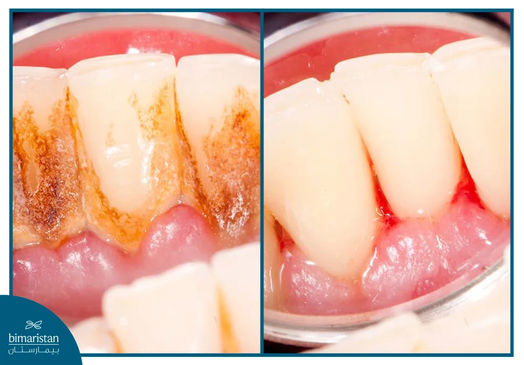 غسول التهاب اللثة: الأنواع والفوائد وطريقة الاستخدام 2 صورة توضح تشكل اللويحات السنية نتيجة عدم استعمال غسول التهاب اللثة