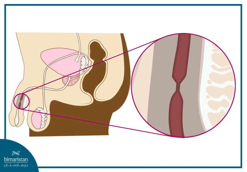 إعادة بناء الجهاز البولي التناسلي: الدليل الشامل 4 صورة توضح حالة تضيق الإحليل