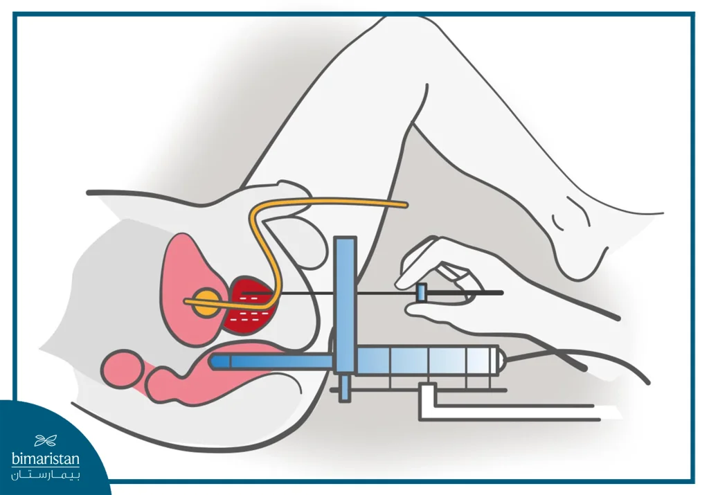 البذور المشعة الدائمة للبروستاتا: مراجعة شاملة 3 صورة توضح خطوات تطبيق البذور المشعة الدائمة للبروستاتا