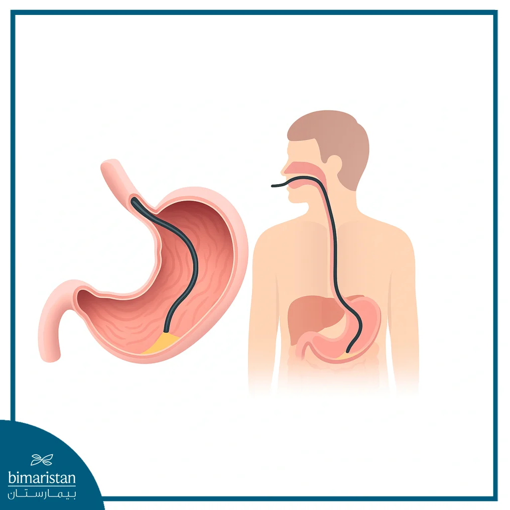 بوتوكس المعدة في تركيا: أفضل علاج للسمنة 2025 4 صورة توضح طريقة وضع بوتوكس المعدة.