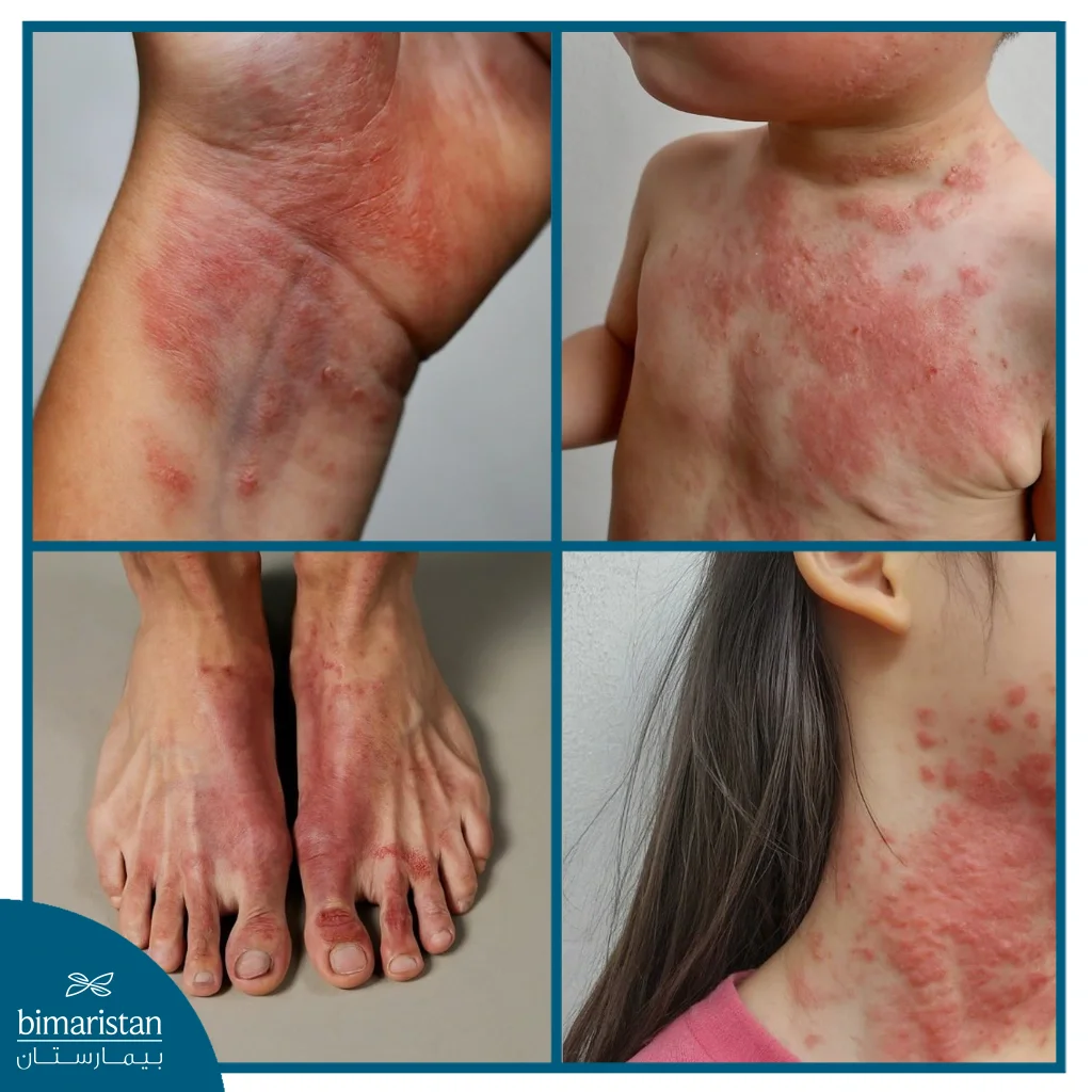 صورة توضح عدة حالات من الأكزيما في مناطق مختلفة من الجسم مع علامات سريرية واضحة