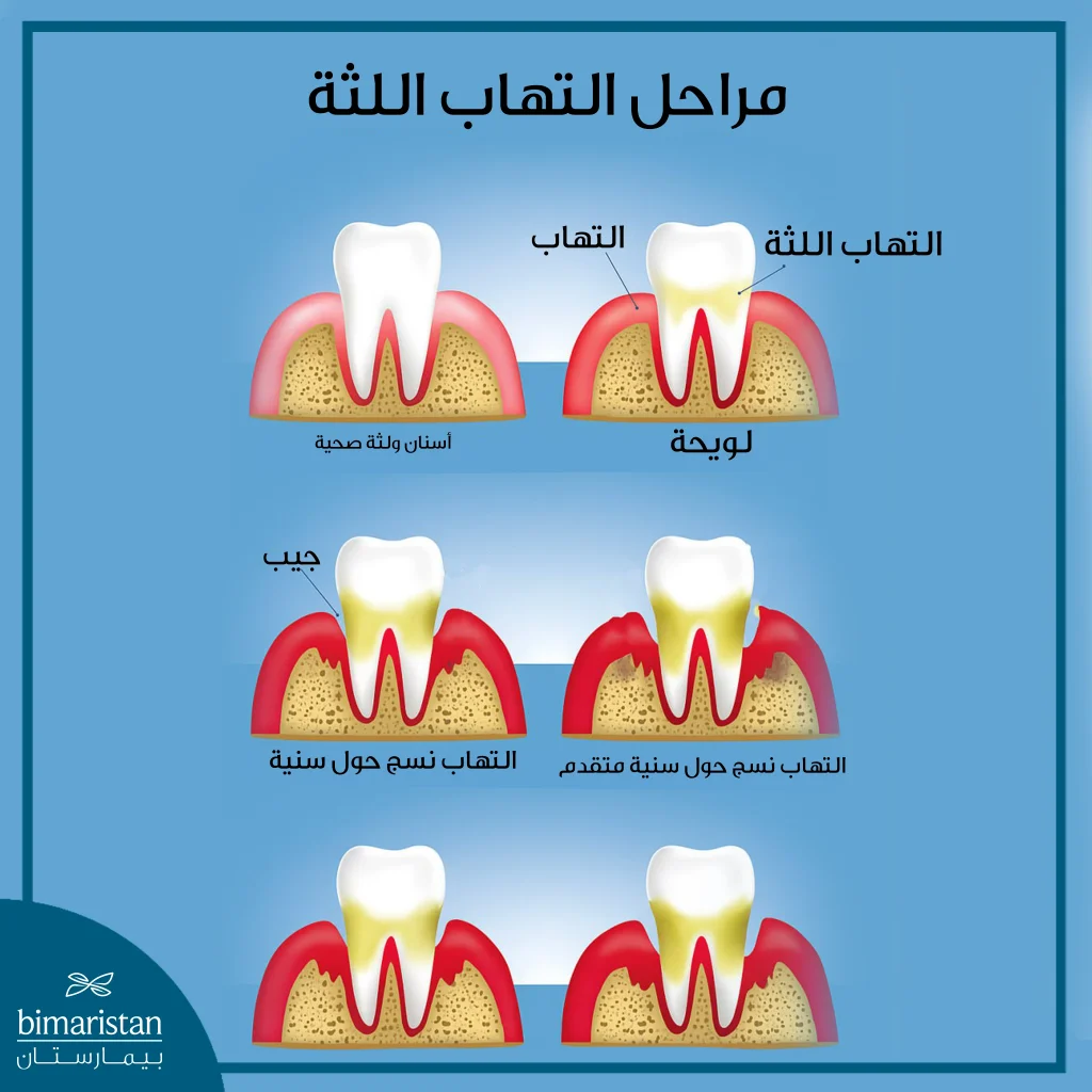أسباب نزيف اللثة: علامة بسيطة أم إنذار لمرض خطير 2 صورة توضح مراحل التهاب اللثة
