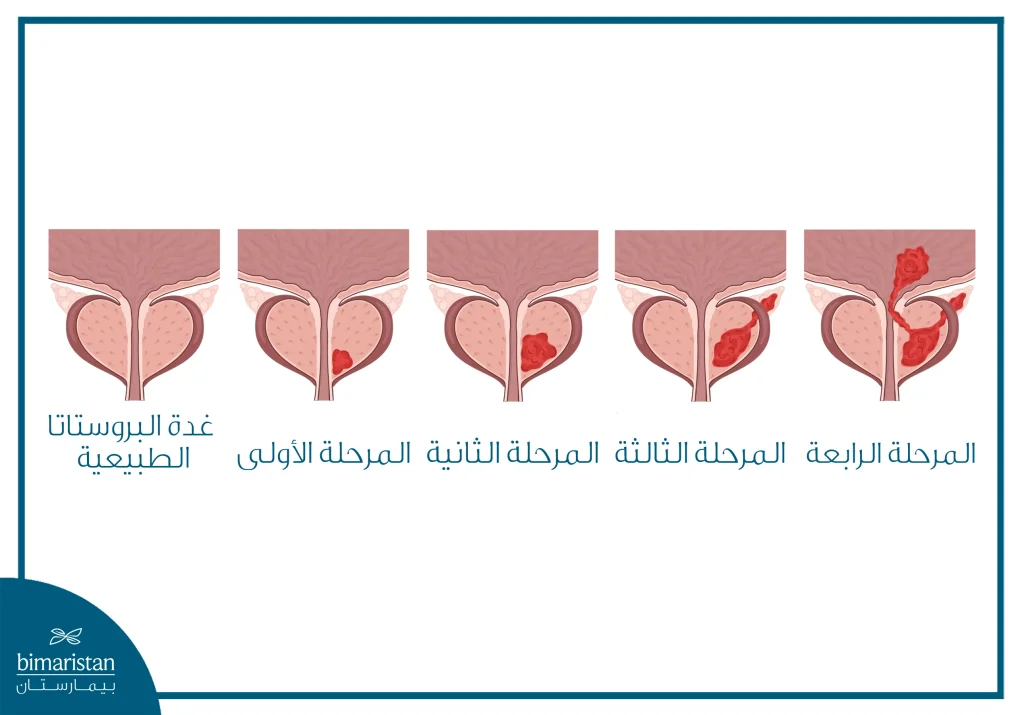 صورة توضح مراحل سرطان البروستاتا