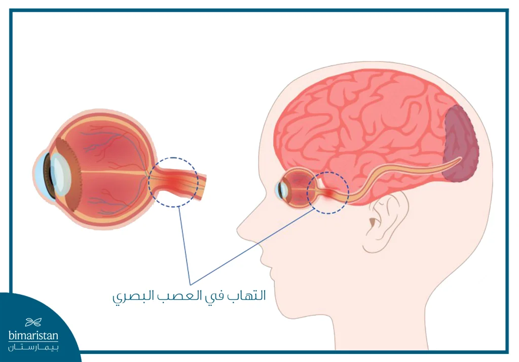 التهاب العصب البصري: الأسباب والأعراض وخيارات العلاج الحديثة 3 صورة توضح مكان توضع الالتهاب في مرض التهاب العصب البصري