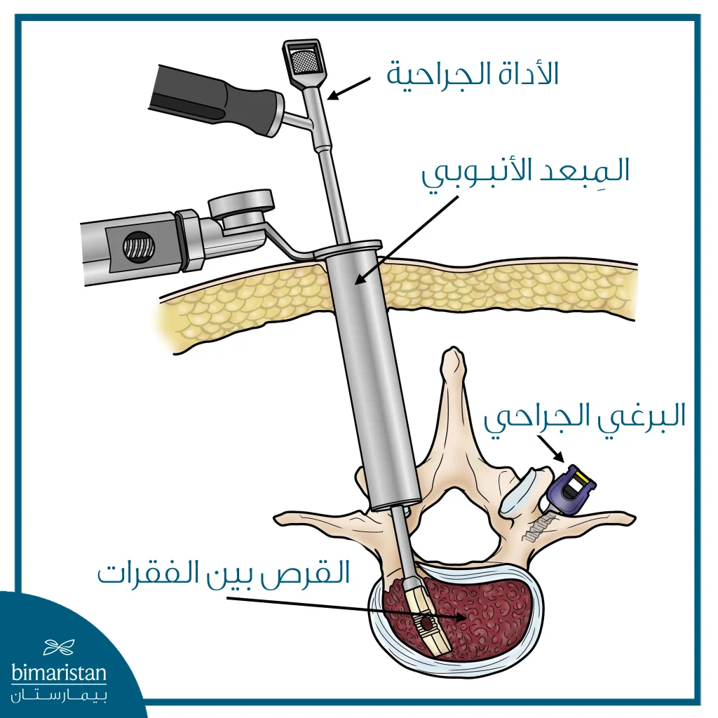 جراحة العمود الفقري طفيفة التوغل 12 صورة توضّح طريقة إجراء الجراحة طفيفة التوغل