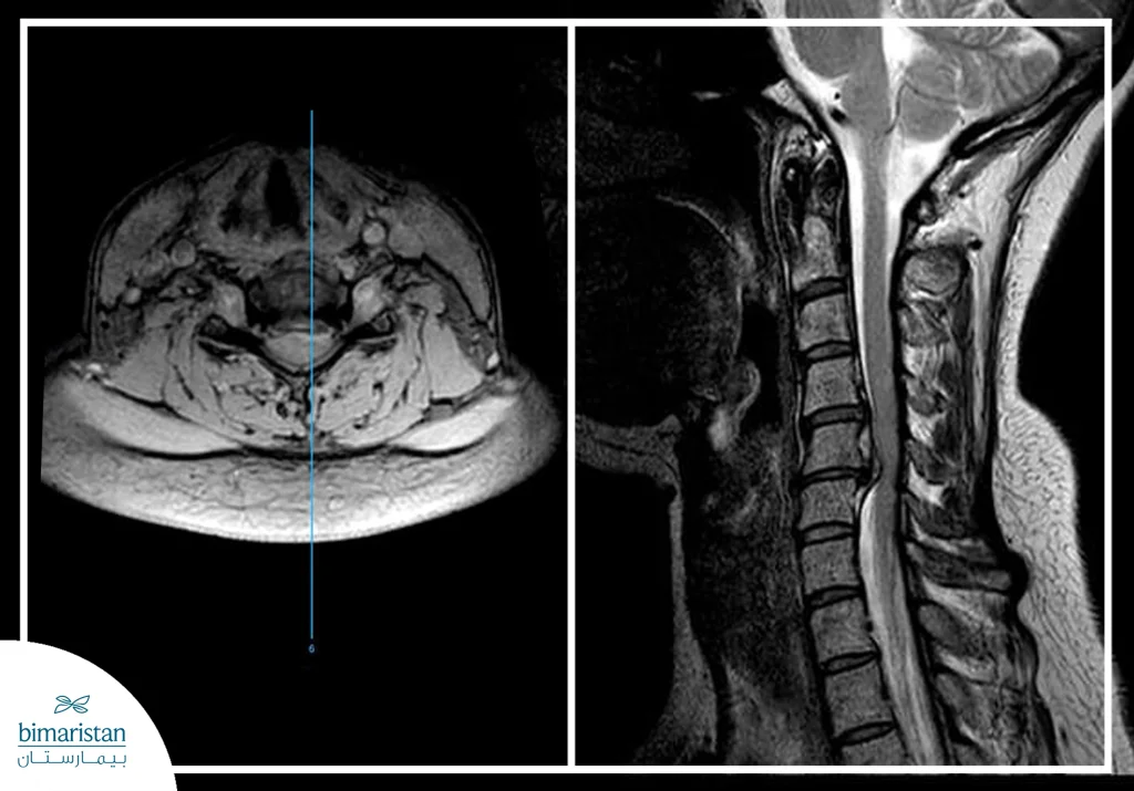 أسباب ديسك الرقبة: أبرز العوامل وراء الانزلاق الغضروفي العنقي 3 صورة شعاعية تظهر انفتاق ديسك الرقبة