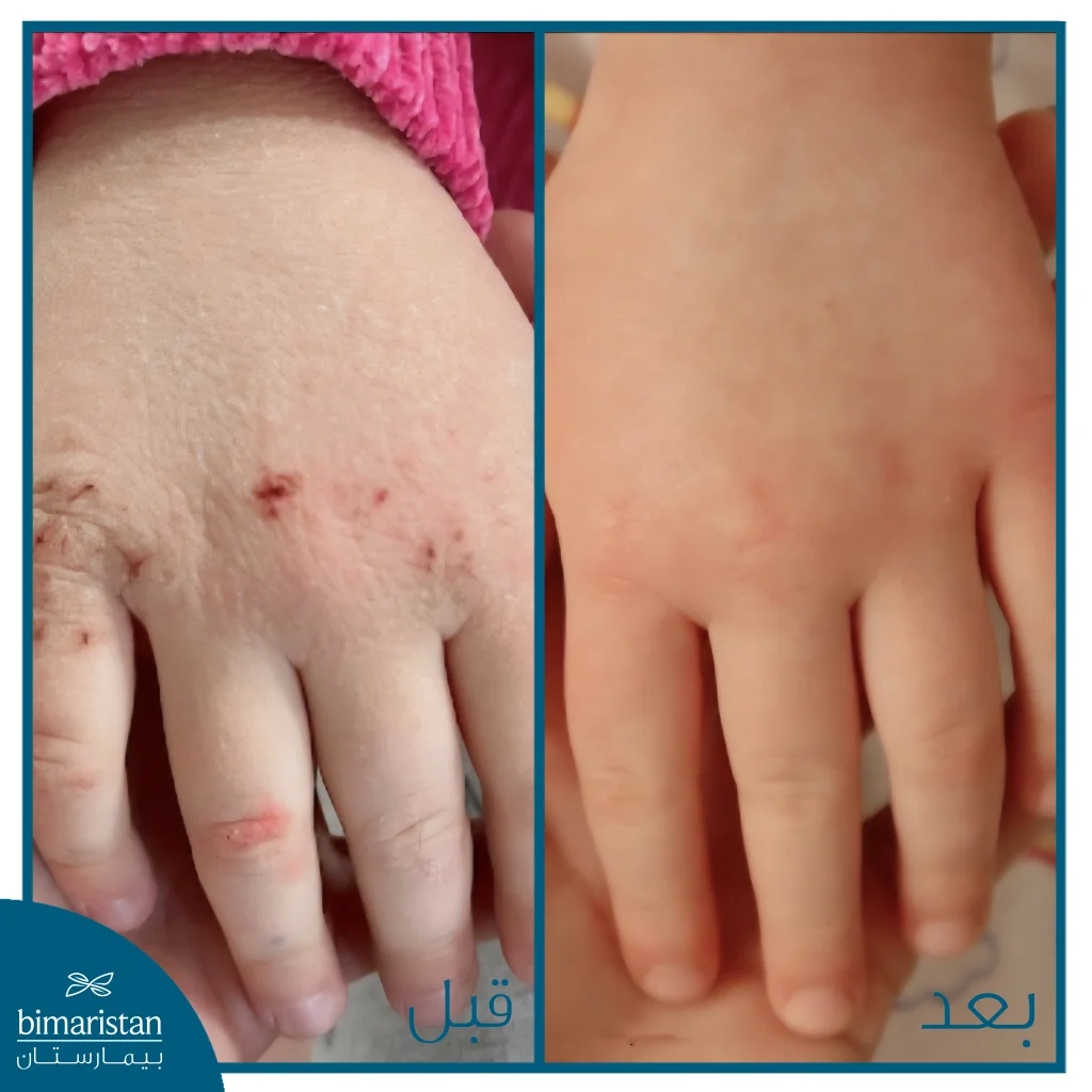 صورة قبل وبعد العلاج بالستيروئيدات تُظهر تحسّن واضح في حالة الجلد واختفاء التشققات والجروح.