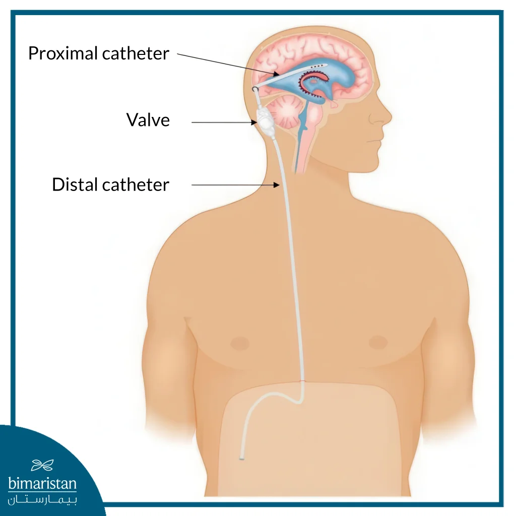 An Image Showing Ventriculo-Peritoneal Shunt (Vps)