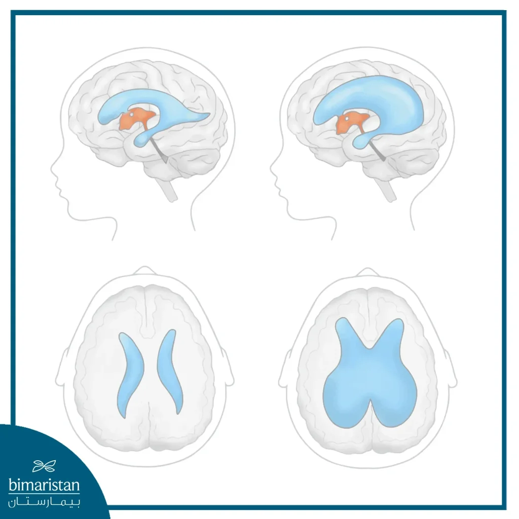 An Image Showing The Difference In Ventricles In Hydrocephalus