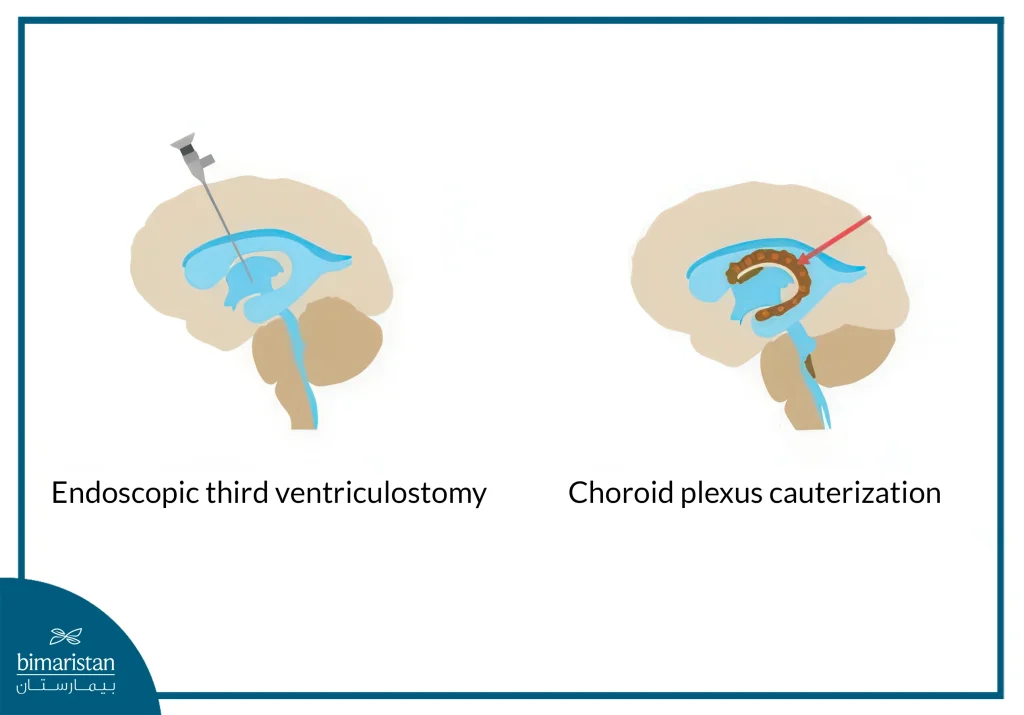 An Image Showing Endoscopic Third Ventriculostomy (Etv) With  Choroid Plexus Cautery