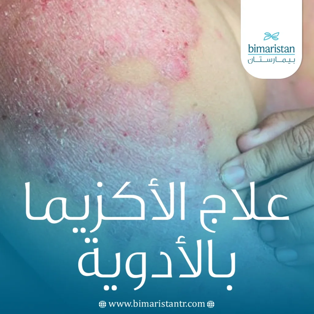 دليل علاج الأكزيما بالأدوية حسب شدة الحالة - بيمارستان