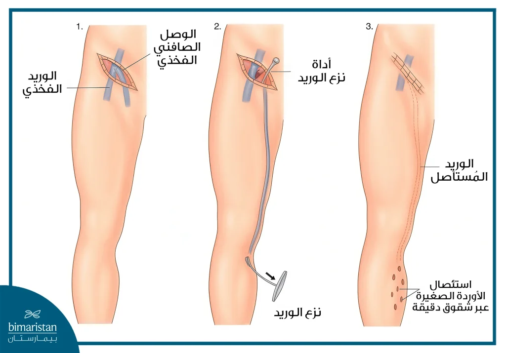 صورة توضح طريقة النزع الوريدي
