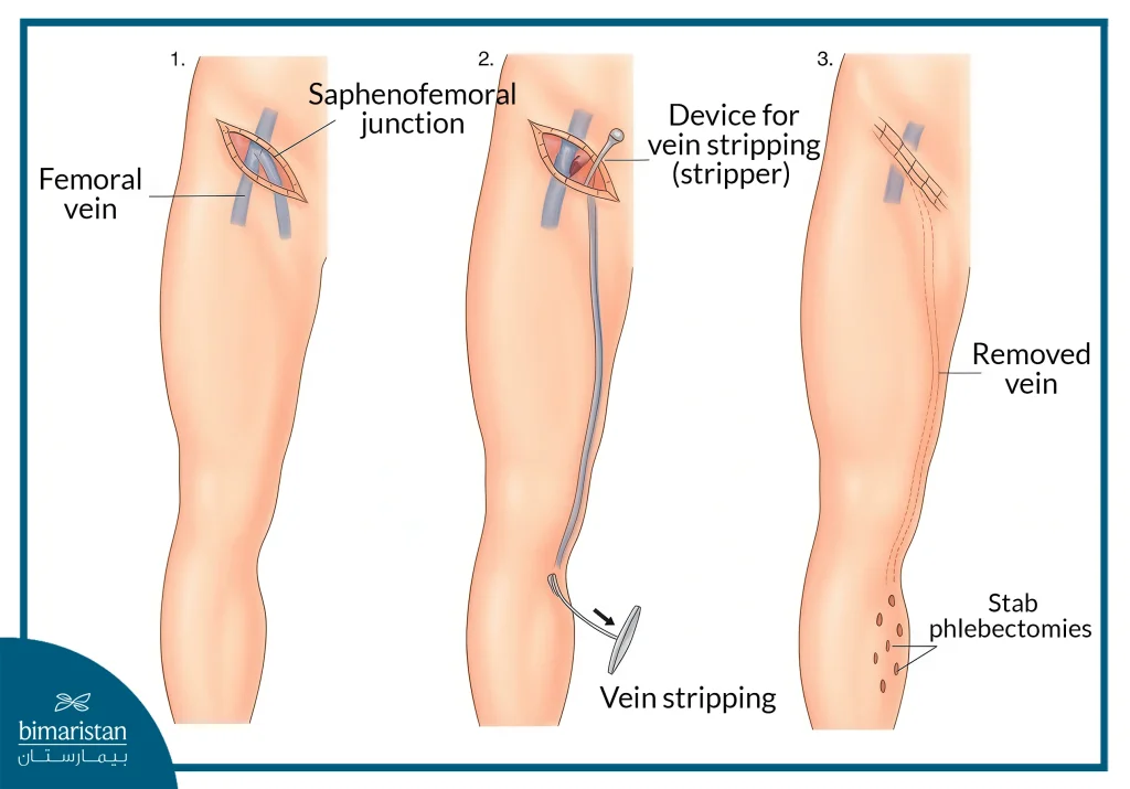 علاج الدوالي بالليزر أم بالجراحة 1 Eng