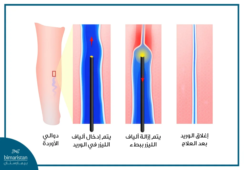 صورة توضح خطوات علاج الدوالي بالليزر