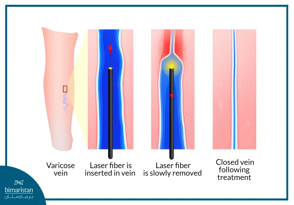 Laser Treatment Of Varicose Veins
