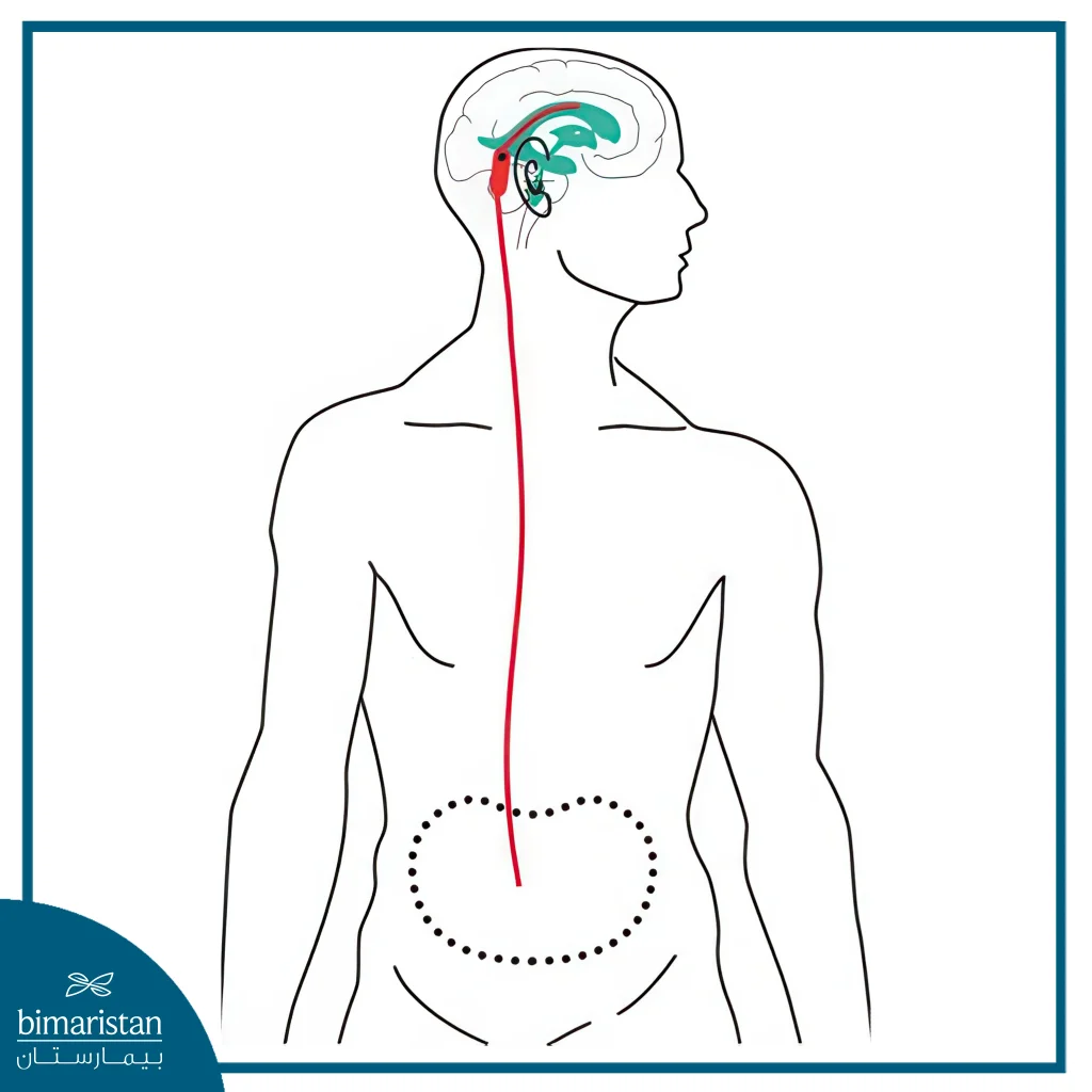 تحويلة من الدماغ إلى تجويف البطن