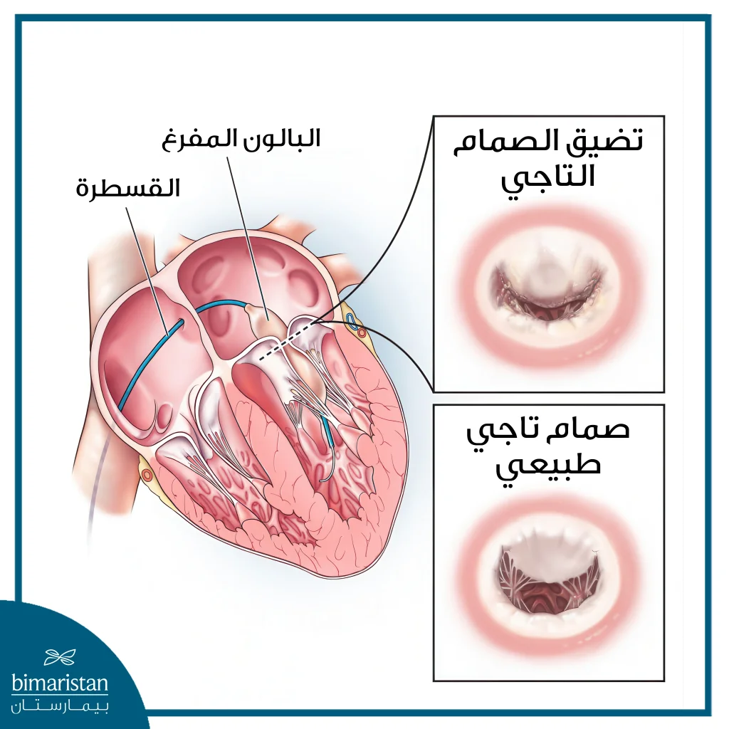 صورة توضح طريقة توسيع الصمام التاجي بالبالون