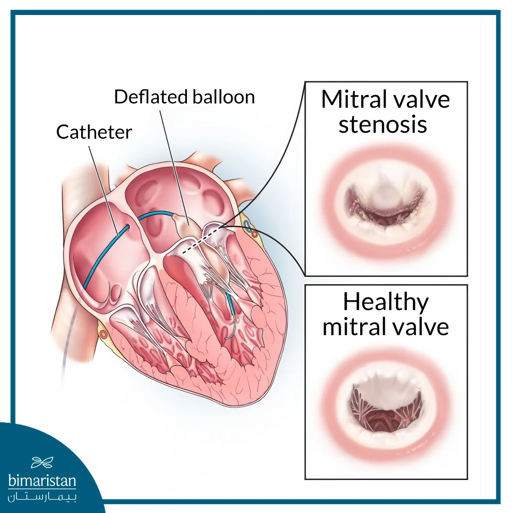 Mitral Valve Balloon Dilatation