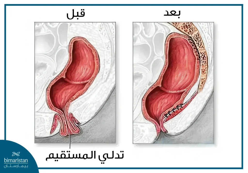 مقارنة بين حالة هبوط المستقيم والحالة الطبيعية بعد عملية إصلاح هبوط المستقيم