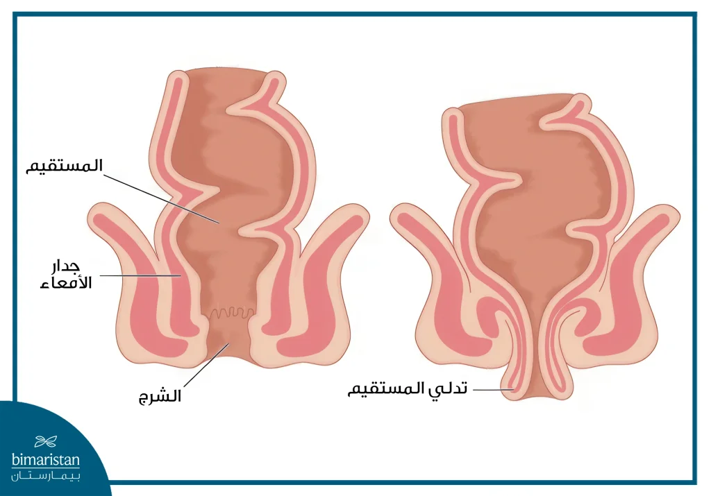 هبوط المستقيم