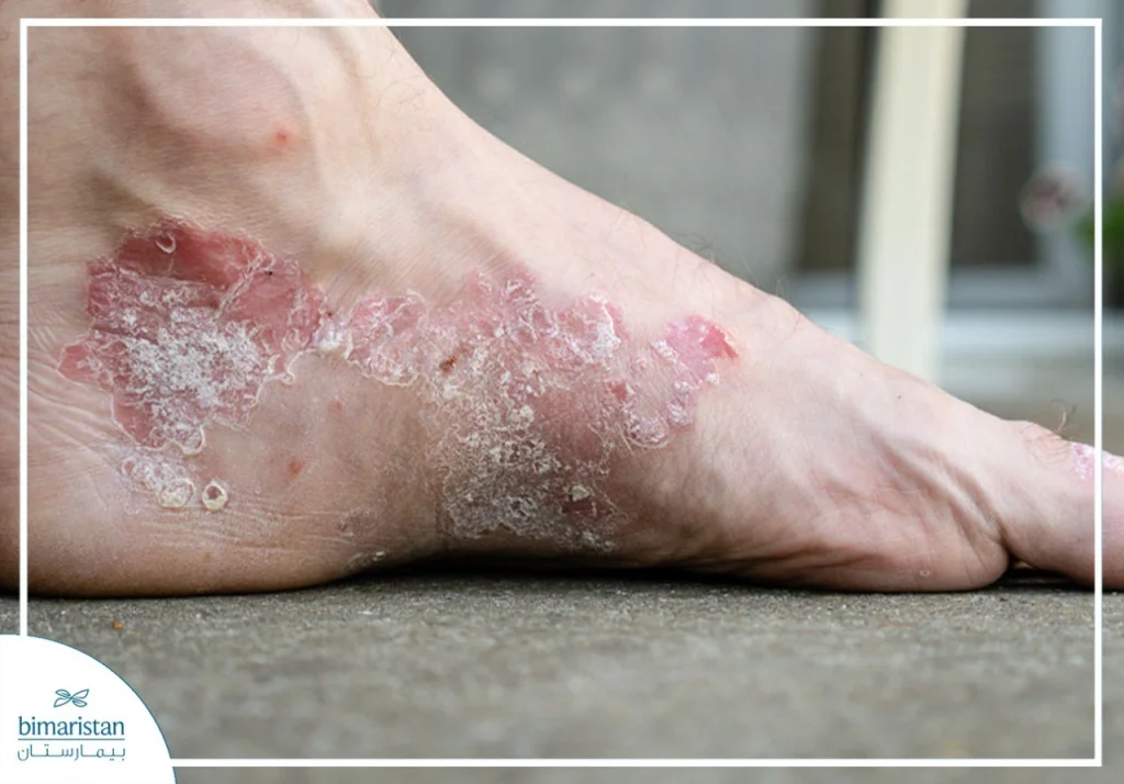 قدم مصابة بالأكزيما مع علامات سريرية واضحة، لمناقشة استراتيجيات علاج الأكزيما