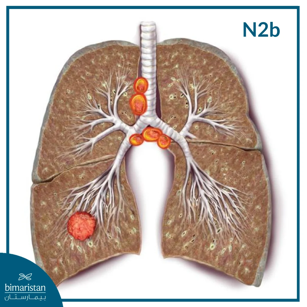 ما هي مراحل سرطان الرئة؟ الدليل الكامل مع شرح كل مرحلة 9 مراحل سرطان الرئة