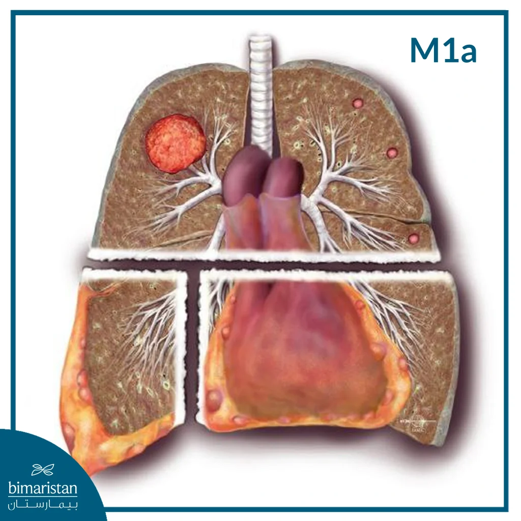 ما هي مراحل سرطان الرئة؟ الدليل الكامل مع شرح كل مرحلة 5 مراحل سرطان الرئة