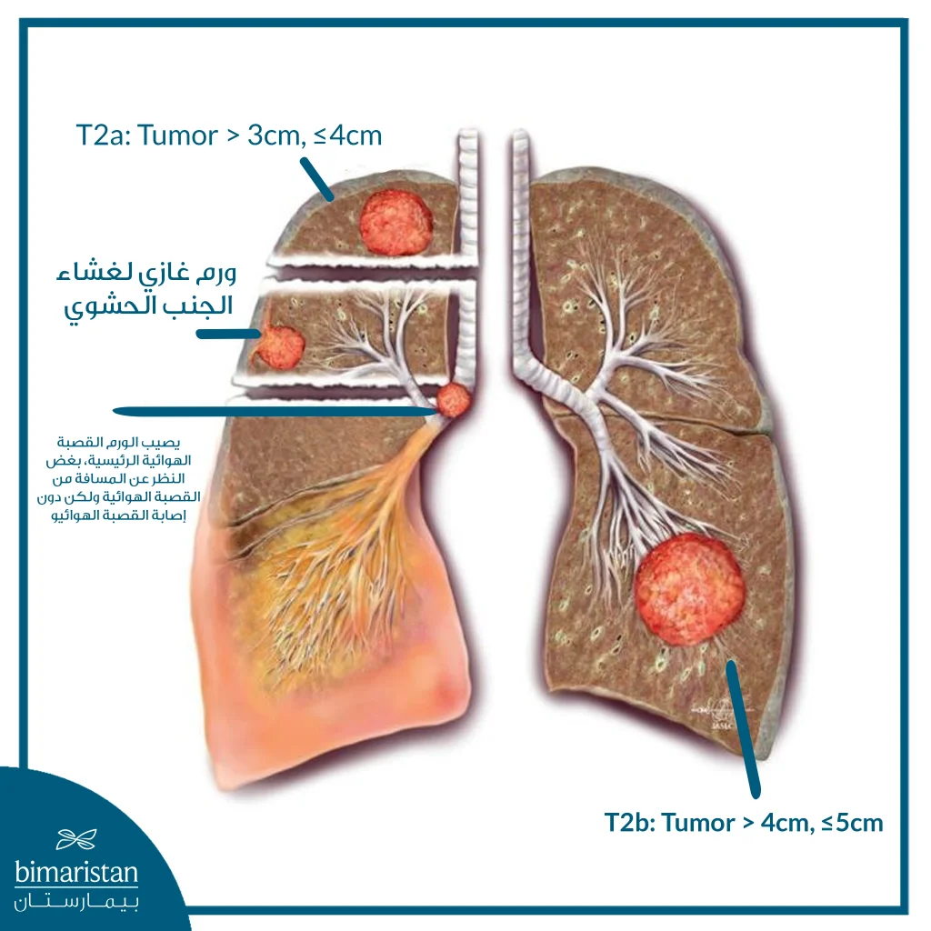 ما هي مراحل سرطان الرئة؟ الدليل الكامل مع شرح كل مرحلة 7 مراحل سرطان الرئة