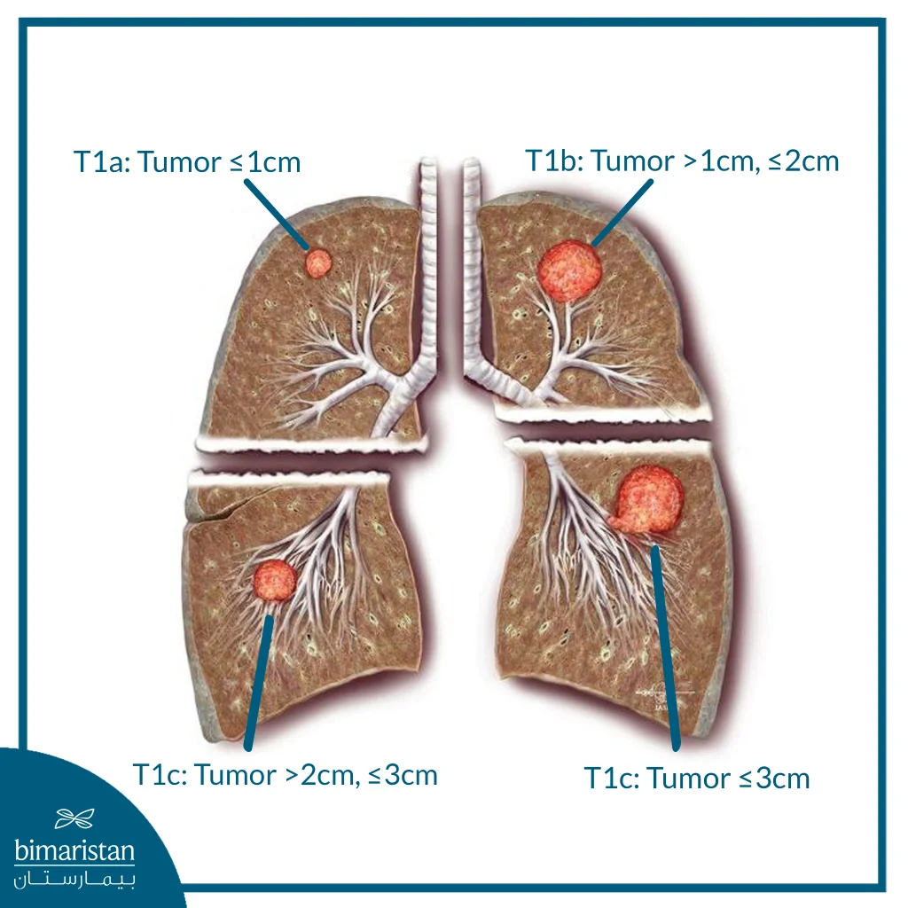 ما هي مراحل سرطان الرئة؟ الدليل الكامل مع شرح كل مرحلة 6 مراحل سرطان الرئة