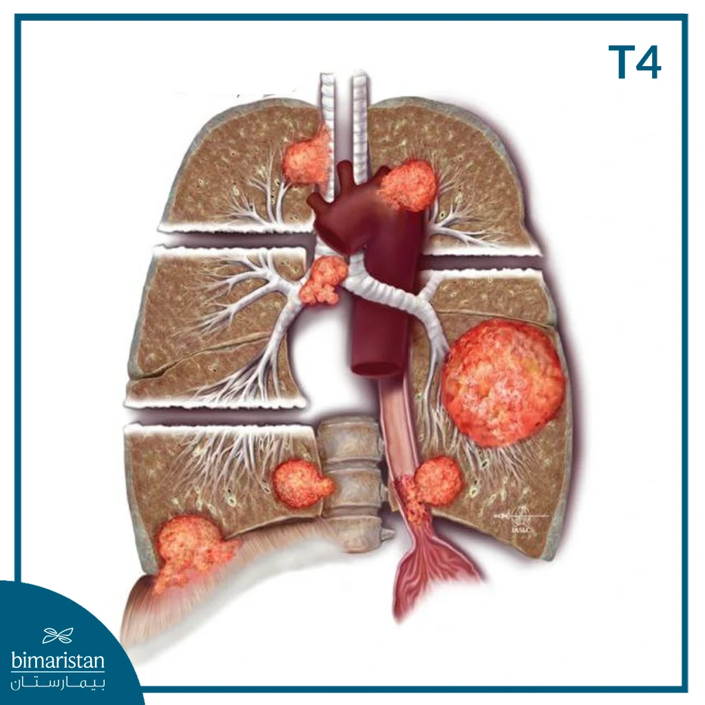 ما هي مراحل سرطان الرئة؟ الدليل الكامل مع شرح كل مرحلة 10 مراحل سرطان الرئة