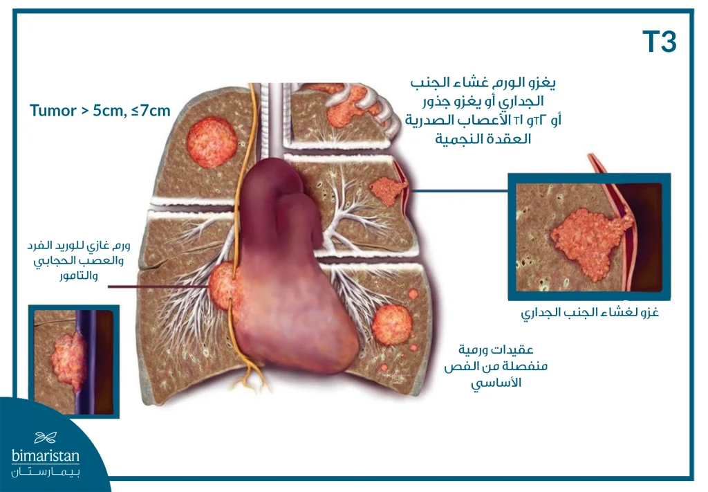 ما هي مراحل سرطان الرئة؟ الدليل الكامل مع شرح كل مرحلة 8 مراحل سرطان الرئة