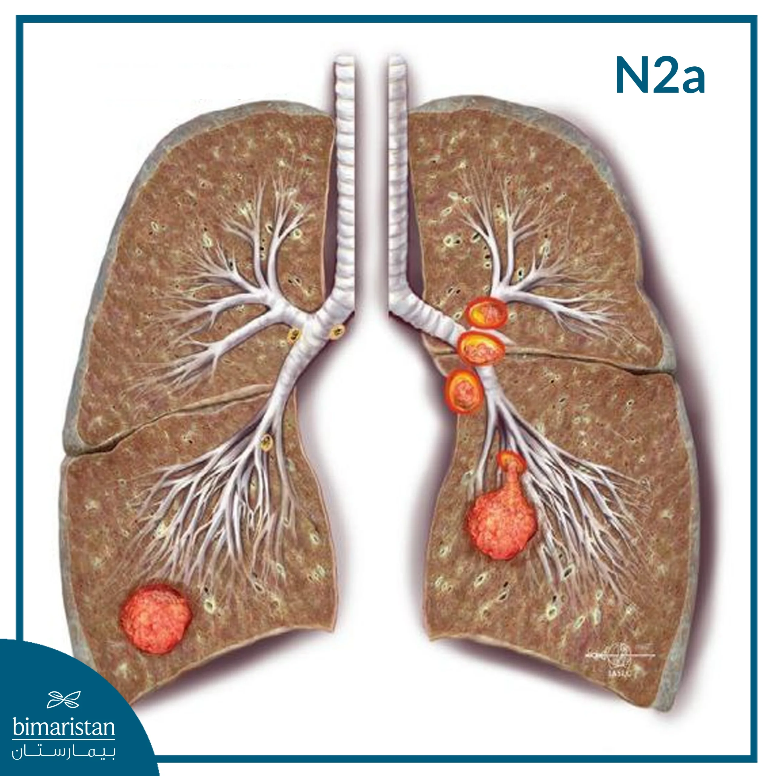 ما هي مراحل سرطان الرئة؟ الدليل الكامل مع شرح كل مرحلة 4 مراحل سرطان الرئة
