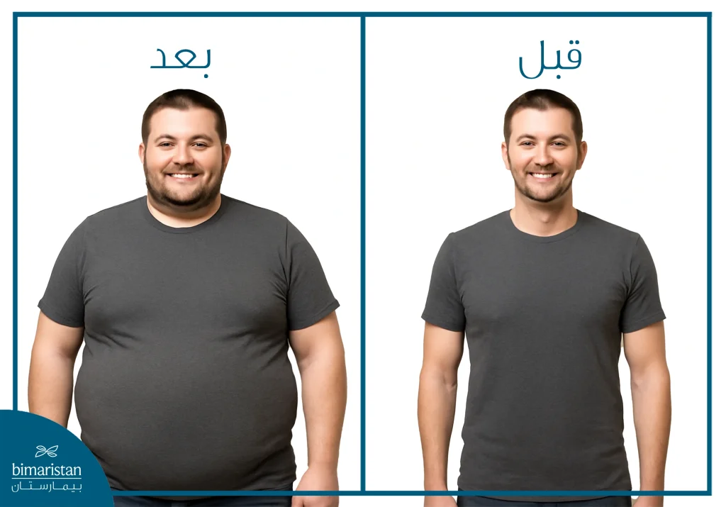 مريض بعد جراحة السمنة بالروبوت.