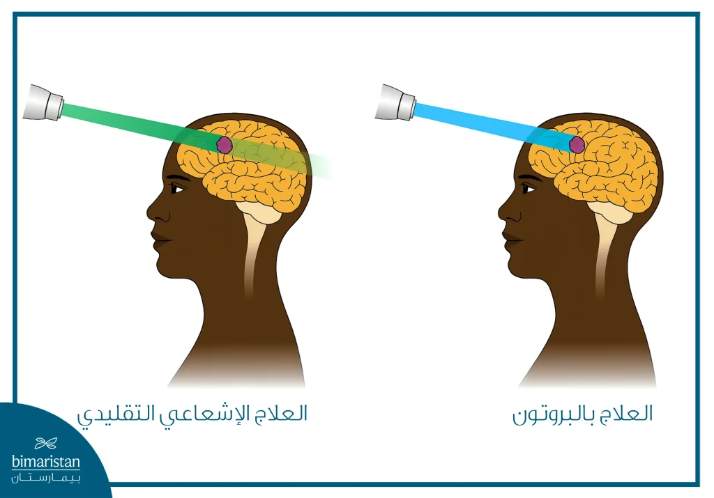 العلاج بالبروتون: أحدث تقنيات علاج السرطان بدقة عالية وأعراض جانبية أقل 3 مقارنة بين العلاج الإشعاعي التقليدي والعلاج بالبروتون في أورام الدماغ