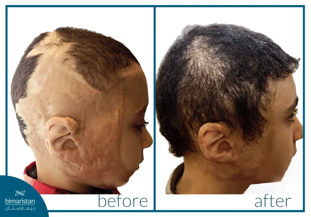 مقارنة قبل وبعد زراعة الشعر لطفل باستخدام تقنيات زراعة الشعر للأطفال والمراهقين