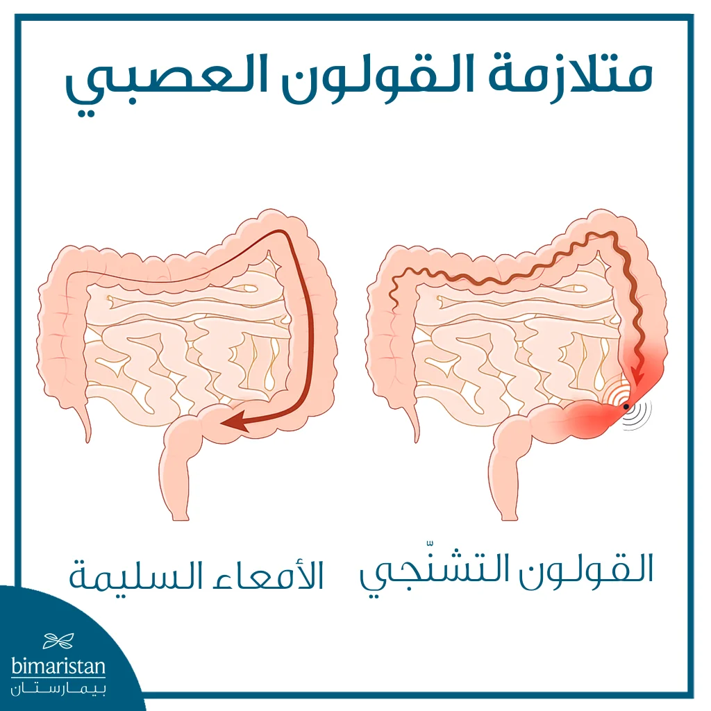 ‎صورة توضح انقباضات غير طبيعية في عضلات الأمعاء في متلازمة القولون العصبي