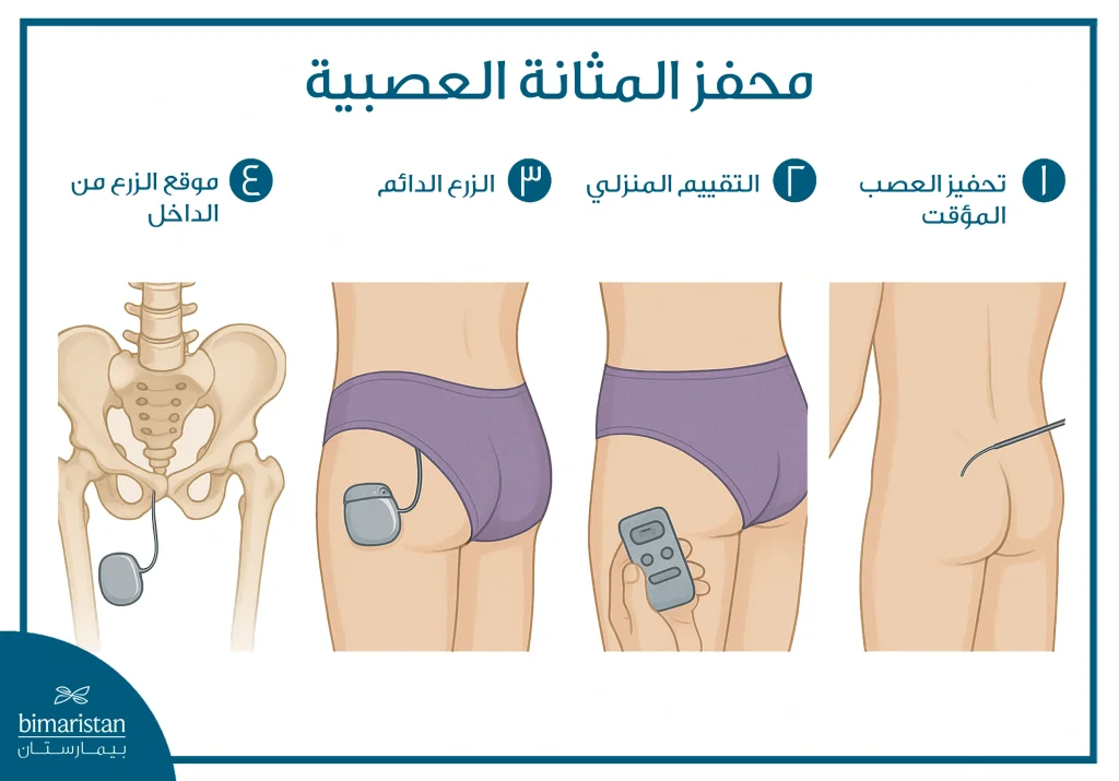 بطارية المثانة العصبية: تقنية للتحكم بالمثانة 2 خطوات تركيب بطارية المثانة العصبية