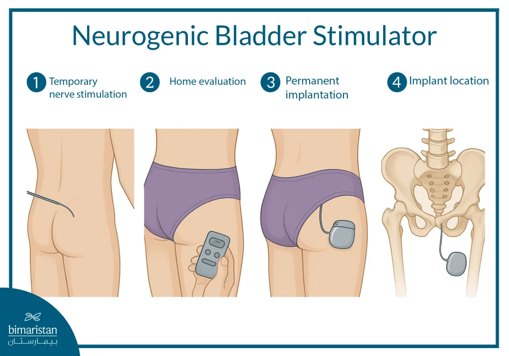 Neurogenic Bladder Battery Explained: A New Era In Urinary Management 2 03 Eng