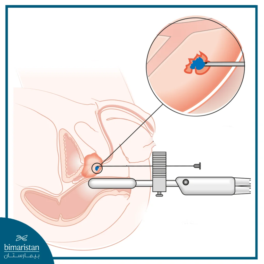 Prostate Specific Antigen (Psa Test) 3 An Image Illustrating The Mechanism Of A Guided Biopsy To Confirm The Presence And Type Of Cancer Cells After An Elevated Prostate-Specific Antigen (Psa) Level.