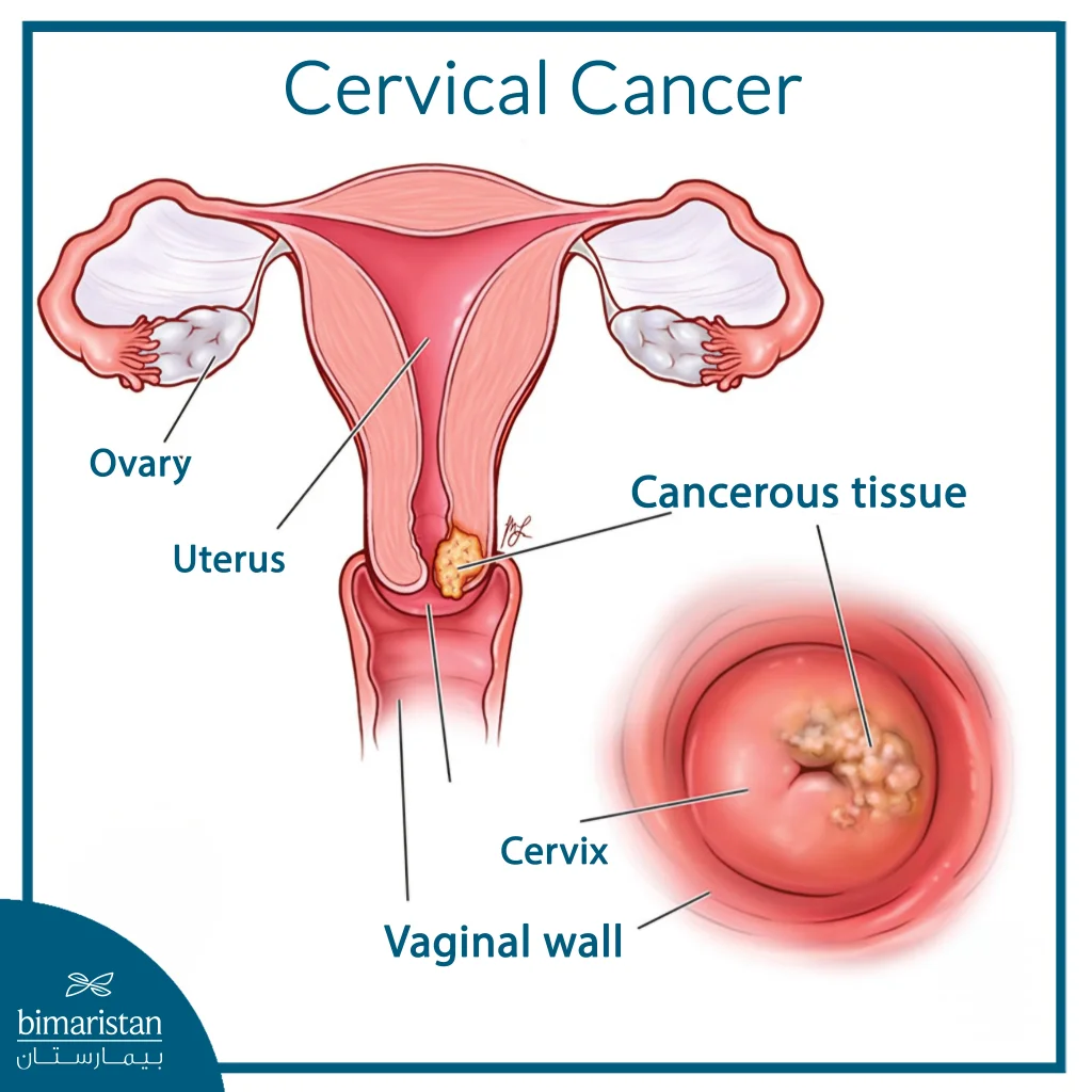 The Image Shows The Location Of Cervical Cancer At The Lower Part Of The Uterus, Where Abnormal Cancerous Cells Grow At The Junction Between The Uterus And Vagina