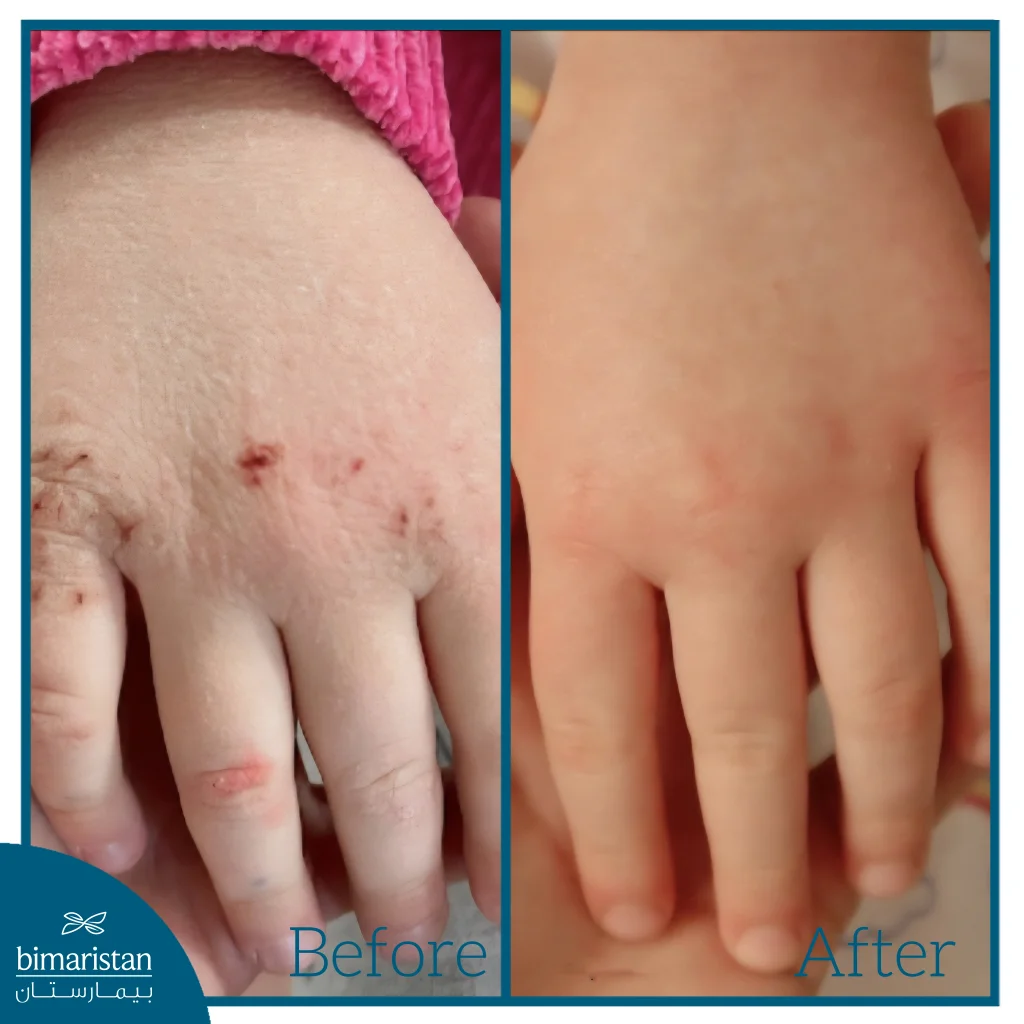 A Before-And-After Image Of Topical Steroid Treatment Showing Clear Improvement In Skin Condition And Disappearance Of Cracks And Wounds