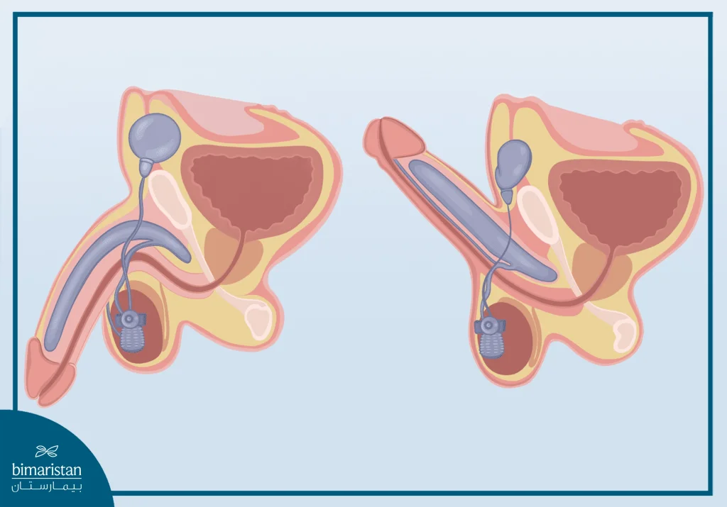 Erectile Dysfunction: Causes, Diagnosis And Treatment 3 An Image Illustrating How A Penile Implant Works.